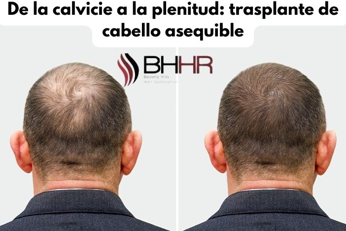 De la calvicie a la plenitud: trasplante de cabello asequible